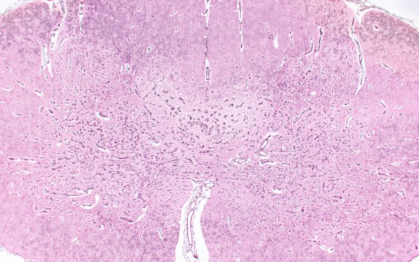 2G9 Leigh Dz (Case 2) L spinal cord Retic 2X