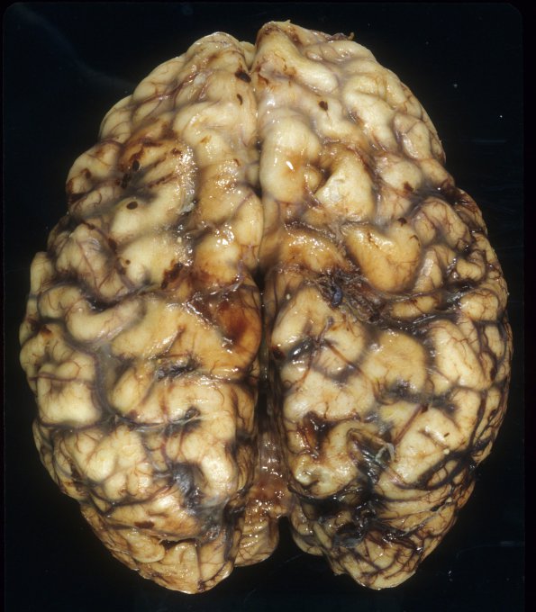 3A1 Leigh Dz (Mitochondrial encephalomyopathy, hepatic encephalopathy, Case 3) A5