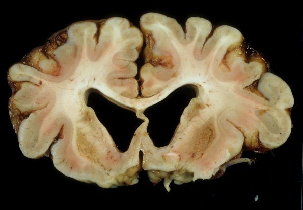 3A2 Leigh Dz (Mitochondrial encephalomyopathy, hepatic encephalopathy, Case 3) A10