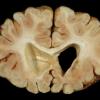 3A3 Leigh Dz (Mitochondrial encephalomyopathy, hepatic encephalopathy, Case 3) A9