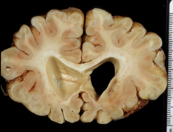 3A3 Leigh Dz (Mitochondrial encephalomyopathy, hepatic encephalopathy, Case 3) A9