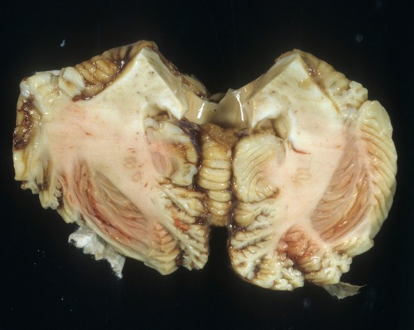 3A4 Leigh Dz (Mitochondrial encephalomyopathy, hepatic encephalopathy, Case 3) A2