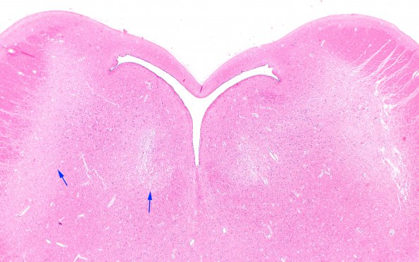 4B2 Leigh Dz (Case 4)-5 Pons H&E 2X copy