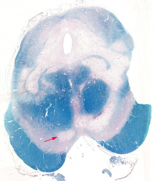 5B4 Leigh Dz (Case 5) Midbrain C Munger whole mount copy