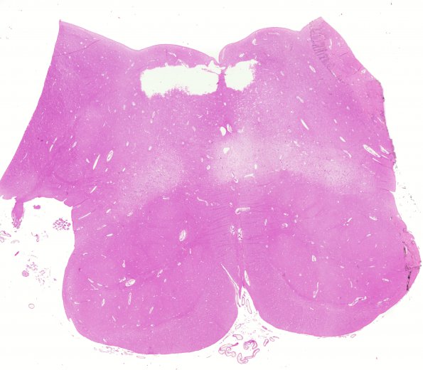 5D1 Leigh Dz (Case 5) Medulla F H&E whole mount