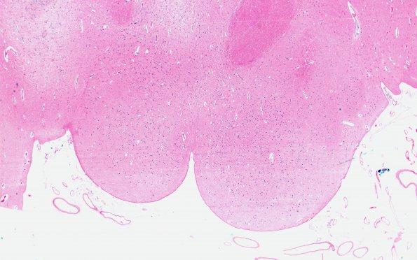 5G2 Leigh Dz (Case 5) A Mamillary bodies 2