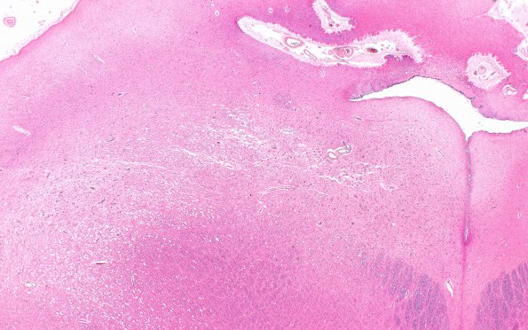 7A2 Leigh Dz (Case 7) H&E 12 (2X)