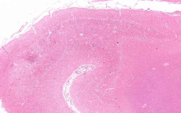 1B1 MELAS (Case 1) N11 (L frontal lobe) H&E 2X