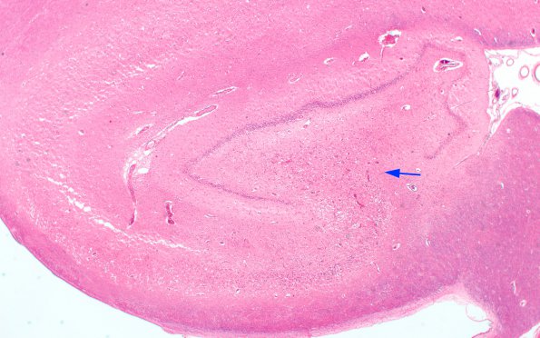 1C1 MELAS (Case 1) N3 H&E 2X copy