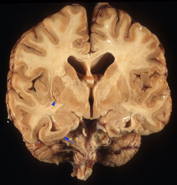2A2 MELAS (Case 2) 2a copy