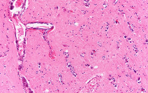 2B3 MELAS (Case 2) N2B Globus Pallidus H&E 1
