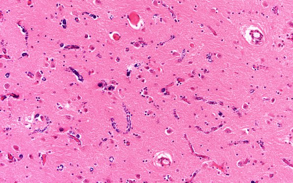 2C3 MELAS (Case 2) N4 Thal H&E 2