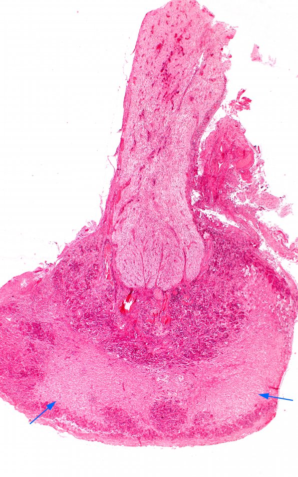 2E1  MELAS (Case 2) N14 Pituitary H&E 2X copy