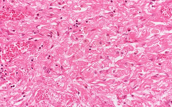 2E2 MELAS (Case 2) N14 Pituitary H&E 3