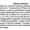 0A Menkes disease - Text