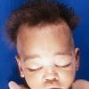 1A1 Menke's Disease, Hair (Case 1) 1