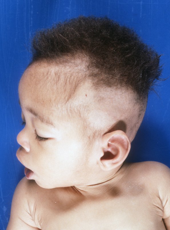 1A2 Menke's Disease, Hair (Case 1) 2