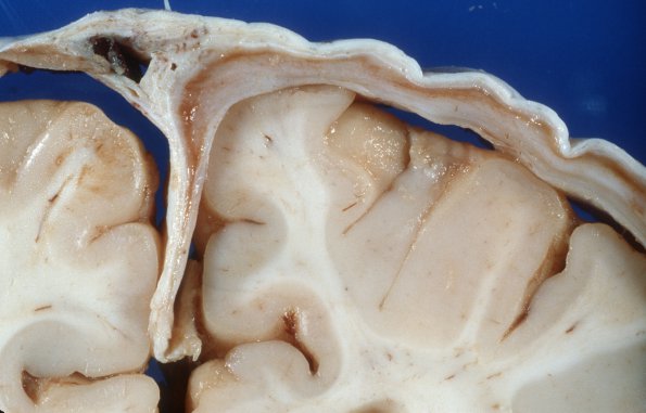 1B2 Menke's Disease, Subdural Hygroma (Case 1) 2