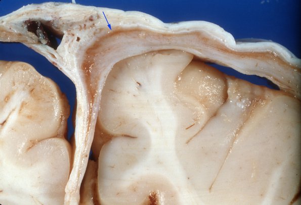 1B3 Menke's Disease, Subdural Hygroma (Case 1) 3 copy