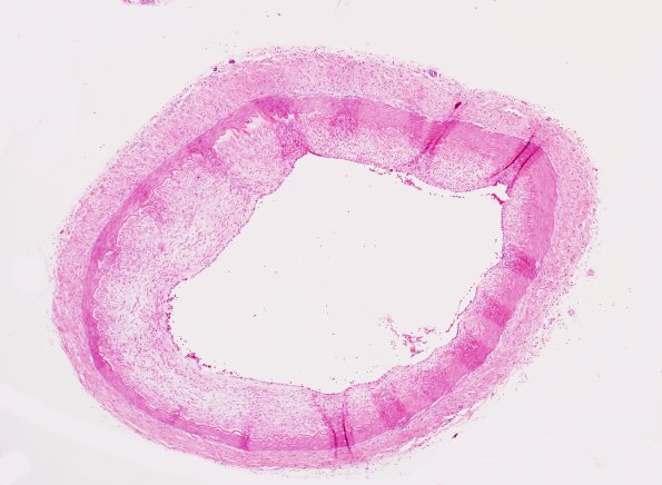 1D2 Menkes Dz (Case 1) artery H&E 2