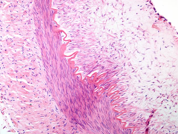 1D3 Menkes Dz (Case 1) artery H&E 1A