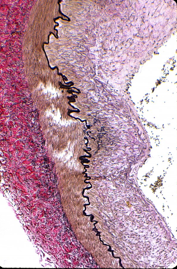 1D4 Menkes Dz (A32217) Vertebral-Basilar Arteries - VVG (elastin) 1