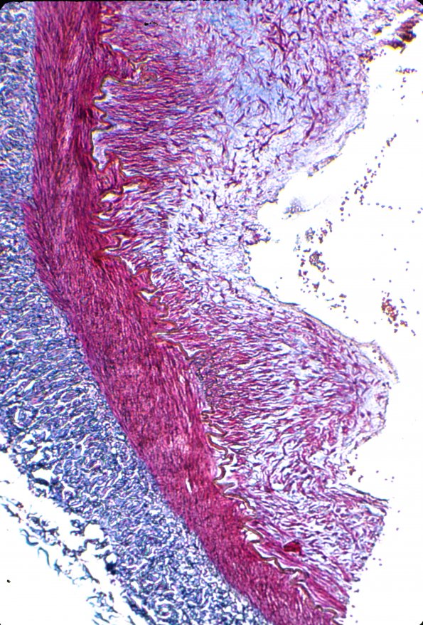 1D5 Menkes Dz (A32217) Vertebral-Basilar Arteries - Trichrome 1