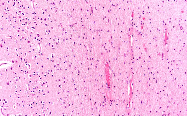 1E2 Menke's Dz (Case 1) O occipital H&E 10X