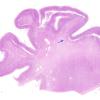 1F1 Menke's Dz (Case 1) P Temporal lobe H&E whole mount copy