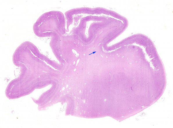 1F1 Menke's Dz (Case 1) P Temporal lobe H&E whole mount copy