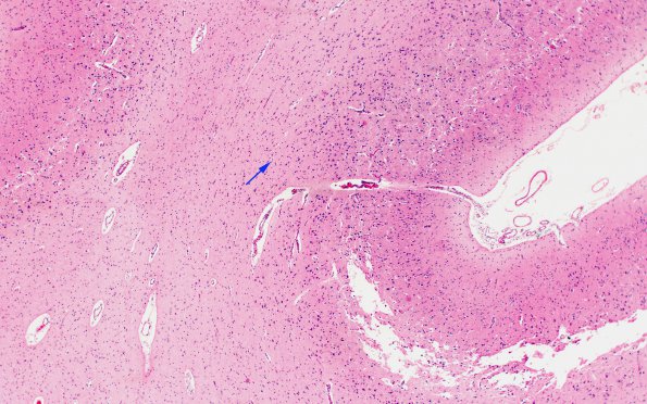 1F2 Menke's Dz (Case 1) P Temporal lobe H&E areaA 3 copy