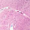 1F3 Menke's Dz (Case 1) P Temporal lobe H&E areaA 5 copy