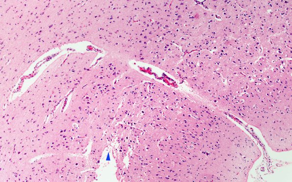 1F3 Menke's Dz (Case 1) P Temporal lobe H&E areaA 5 copy