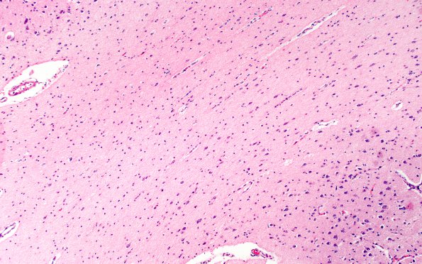 1F4 Menke's Dz (Case 1) P Temporal lobe H&E areaA 4