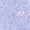 1F5 Menke's Dz (Case 1) P Temporal lobe LFB-PAS areaA 5