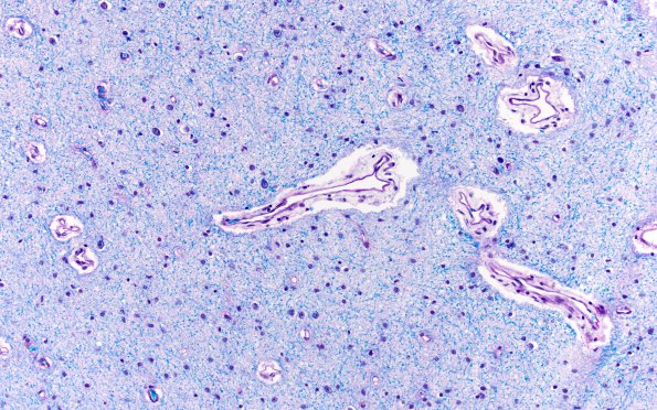 1F5 Menke's Dz (Case 1) P Temporal lobe LFB-PAS areaA 5