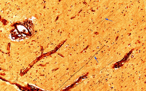 1F6 Menke's Dz (Case 1) P Temporal lobe Biels real copy