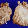 1G1 Menke's Dz (Case 1) Cerebellum 1 copy