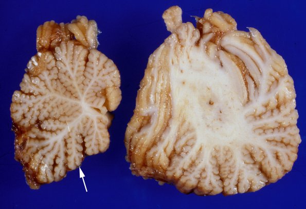 1G1 Menke's Dz (Case 1) Cerebellum 1 copy