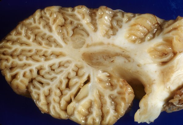 1G2 Menke's Dz (Case 1) Cerebellum 2