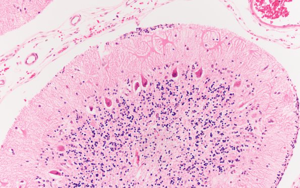 1H7 Menke's Dz (Case 1) E cerebellum H&E 2