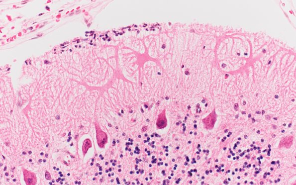 1H8 Menke's Dz (Case 1) E cerebellum H&E 1