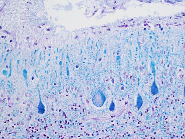 1J Menke's Disease (Case 1) LFB-PAS 1