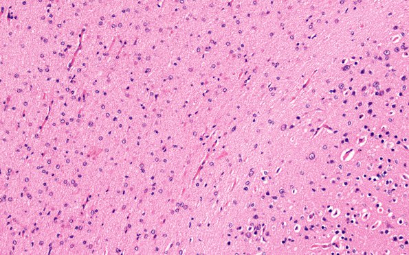 2A11 Menkes, likely mimic (Case 2) H&E N5A hemisphere H&E 2