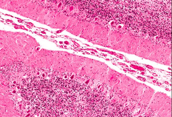 3A2 Menke's Disease (AANP 1987, Case 11) H&E X10 2