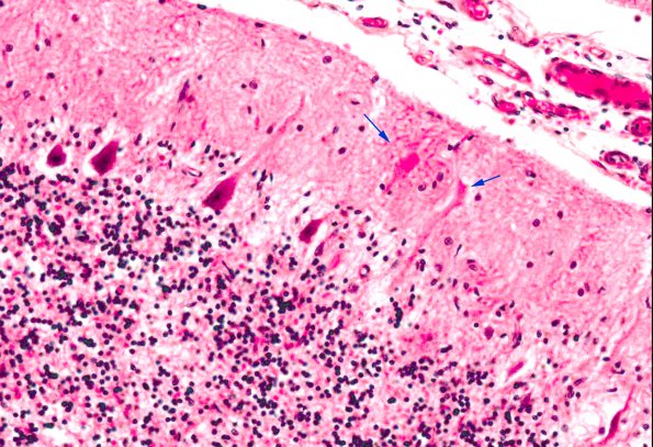 3A3 Menke's Disease (AANP 1987, Case 11) H&E 20X 1 copy