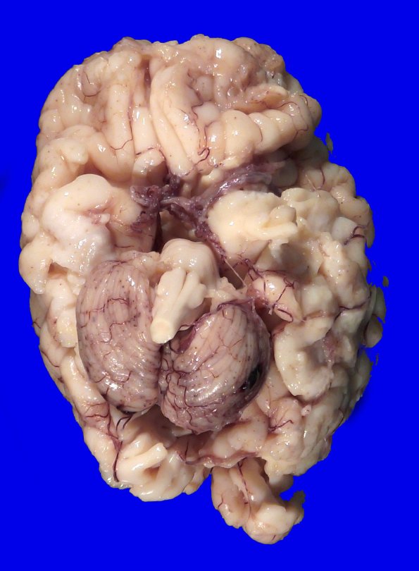 4A1 Menkes Dz (Case 4) Gross 1
