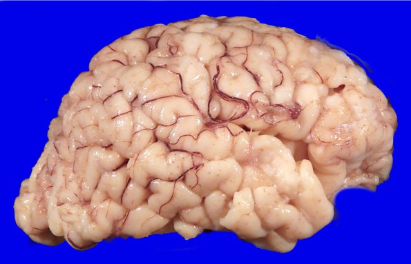 4A2 Menkes Dz (Case 4) Gross 2