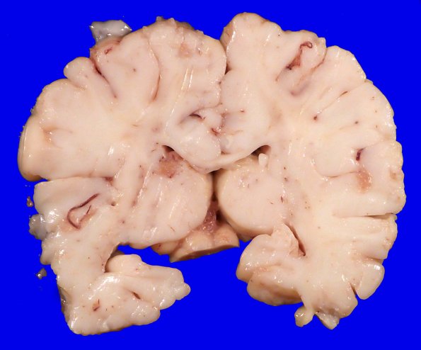 4A3 Menkes Dz (Case 4) Gross 3