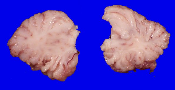 4A4 Menkes Dz (Case 4) Gross 4